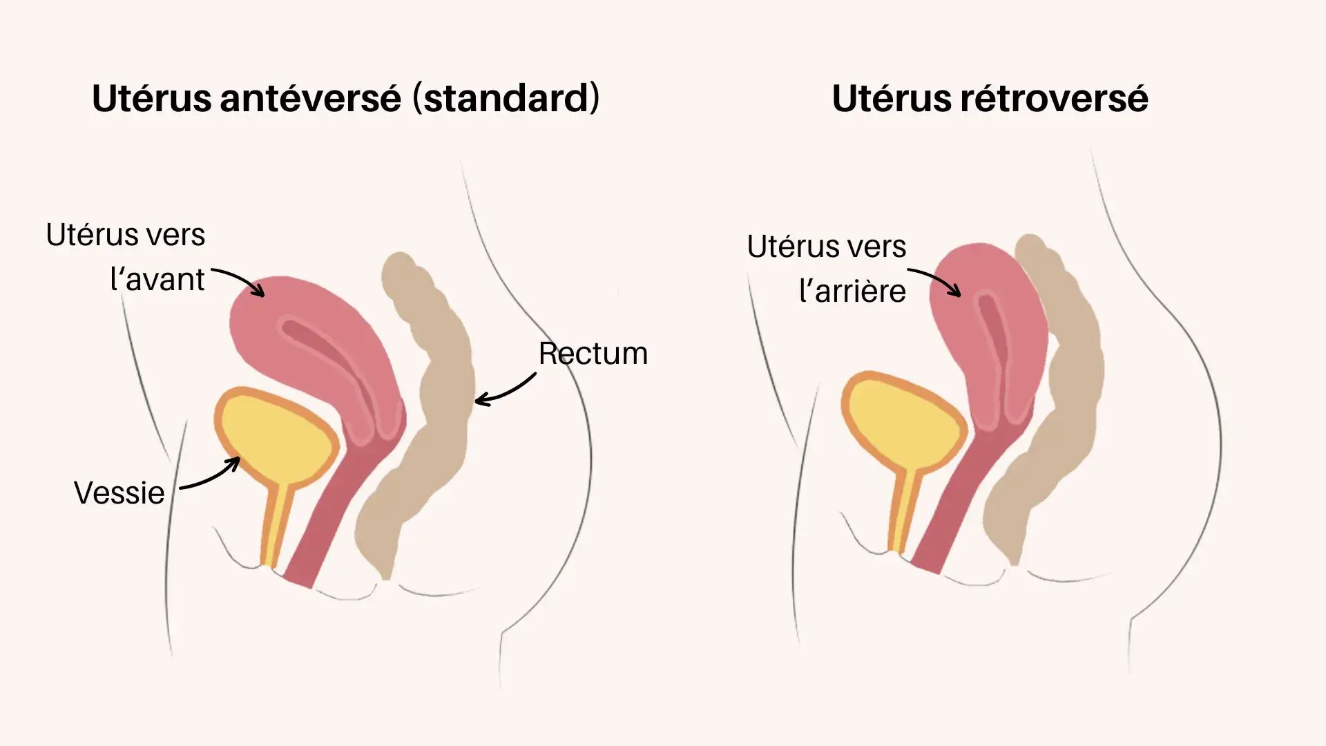 col utérus retroversé et antéversé