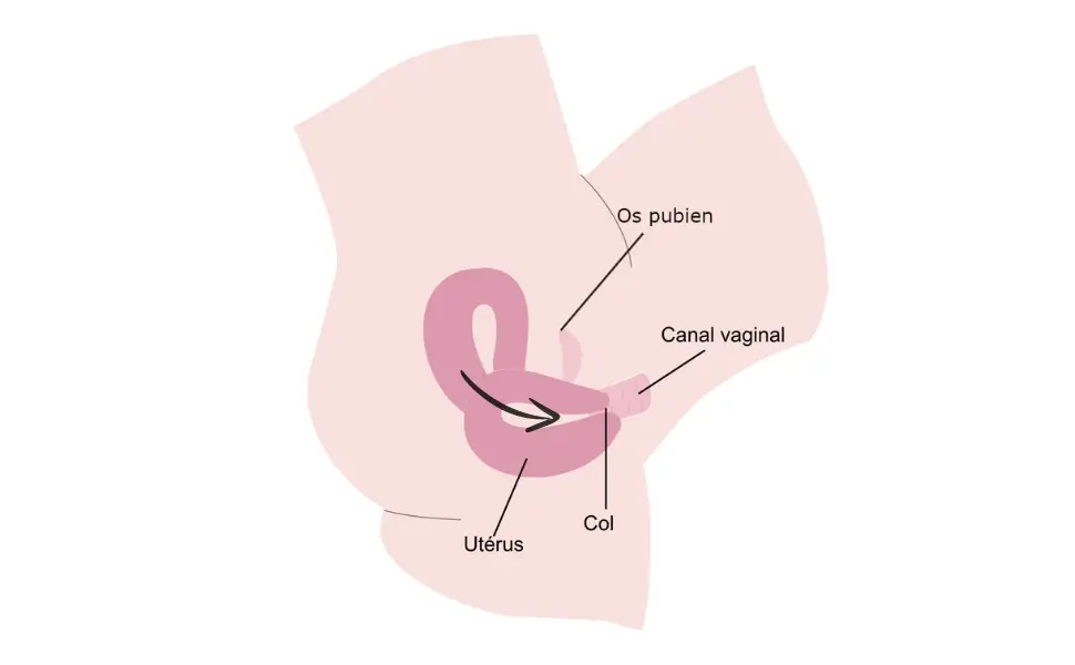 descente d'organes ou prolapsus